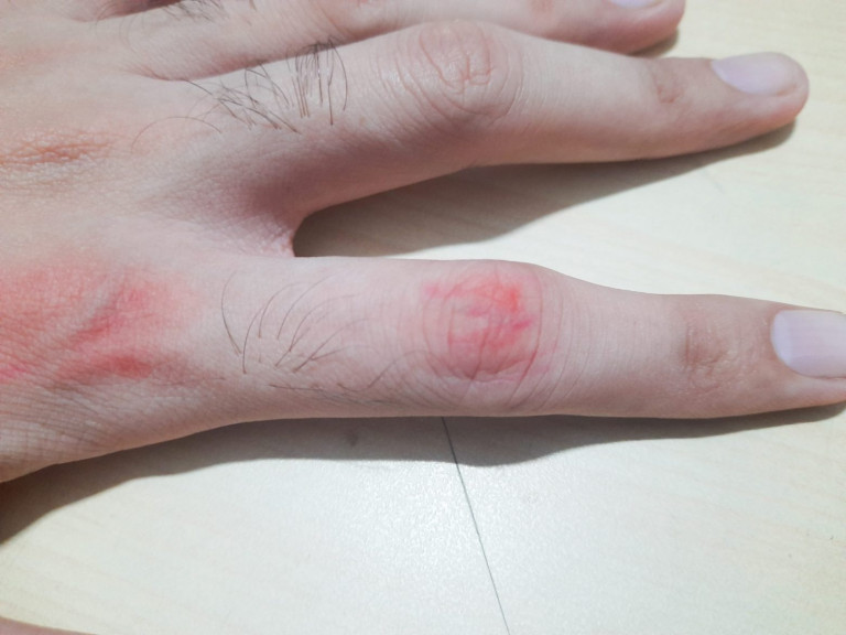 Ρευματοειδής αρθρίτιδα: Καλύτερη θεραπεία η συνεργασία γιατρού – ασθενή