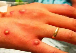 Παγώνη: Ποια η διαφορά μεταξύ ευλογιάς των πιθήκων και ανεμοβλογιάς