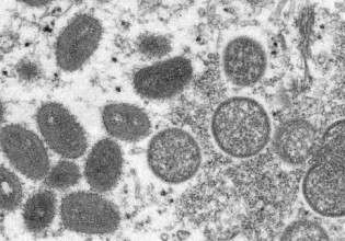 Βασιλακόπουλος: Υπάρχει εμβόλιο για την Ευλογιά των πιθήκων – Περισσότερο μάς ανησυχεί η ΒΑ.5