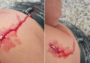 ΚΕΕΡΦΑ: Φασίστες μαχαίρωσαν μετανάστη στον Κόκκινο Μύλο