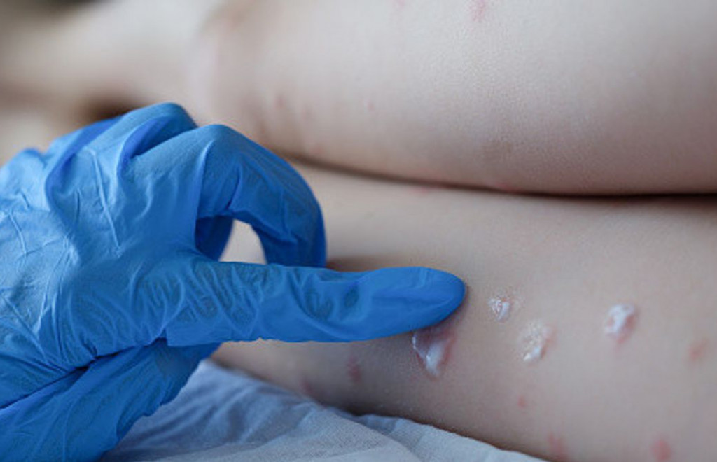 Ευλογιά των πιθήκων: Ποιοι θα εμβολιαστούν – Τι αποφάσισε η Εθνική Επιτροπή Εμβολιασμών