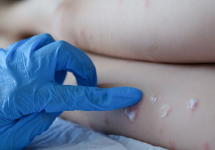 Ευλογιά των πιθήκων: Ποιοι θα εμβολιαστούν – Τι αποφάσισε η Εθνική Επιτροπή Εμβολιασμών