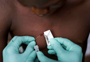 Ευλογιά των πιθήκων: Πόσο εύκολα μεταδίδεται – Τα συμπτώματα, οι θεραπείες και οι φόβοι των ειδικών