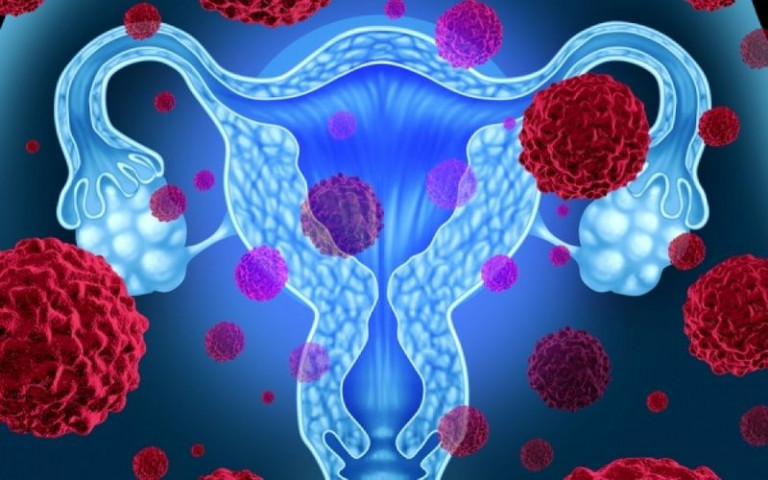Καρκίνος των ωοθηκών: Όλα όσα θέλετε να γνωρίζετε για τον πιο θανατηφόρο γυναικολογικό καρκίνο