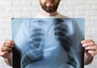 Καρκίνος του πνεύμονα: Γιατί το 41% των ασθενών διαγιγνώσκονται σε προχωρημένο στάδιο