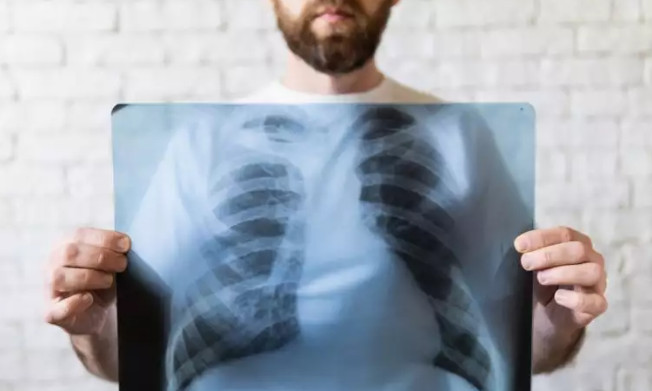 Καρκίνος του πνεύμονα: Γιατί το 41% των ασθενών διαγιγνώσκονται σε προχωρημένο στάδιο