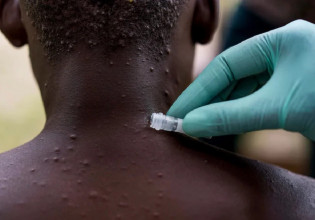 Ευλογιά των πιθήκων: Ενθαρρυντικά τα αποτελέσματα από την πρώτη χρήση αντιικού φαρμάκου