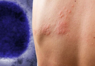 «Ευλογιά των πιθήκων»: Σε εγρήγορση ο ΕΟΔΥ, έστειλε εγκύκλιο στα νοσοκομεία