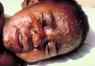 Ευλογιά: Η ξεχασμένη θανατηφόρα ασθένεια