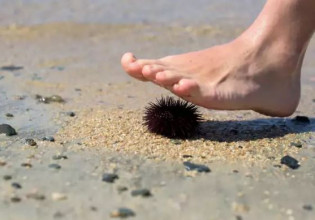Μεγάλη προσοχή! Τι δεν πρέπει να κάνετε με τίποτα αν πατήσετε αχινό