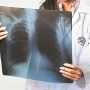 Πρόληψη για τον καρκίνο του πνεύμονα