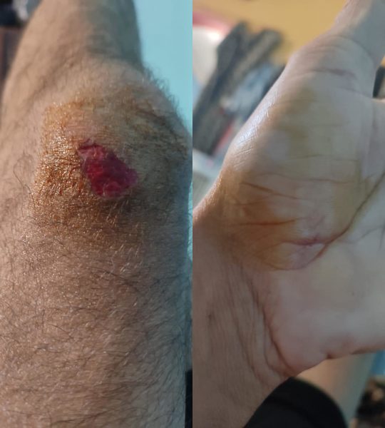 Χαλάνδρι: Νέα άγρια ρατσιστική επίθεση σε μετανάστη εργάτη