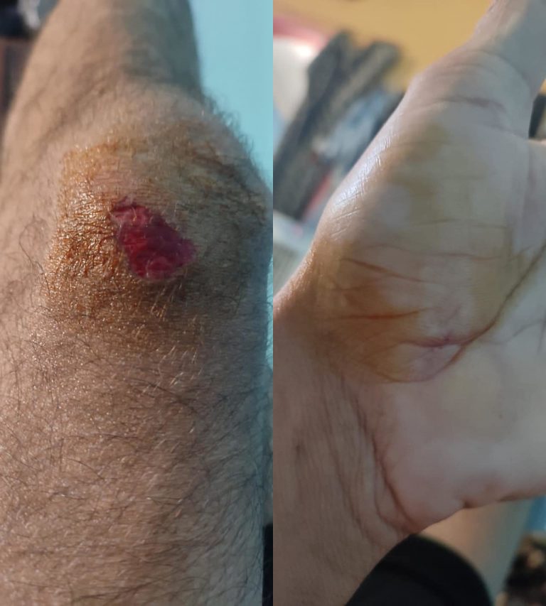 Χαλάνδρι: Νέα άγρια ρατσιστική επίθεση σε μετανάστη εργάτη