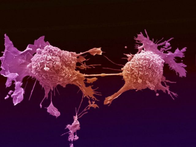 «Ενισχυμένο» μονοκλωνικό αντίσωμα σκοτώνει τα καρκινικά κύτταρα