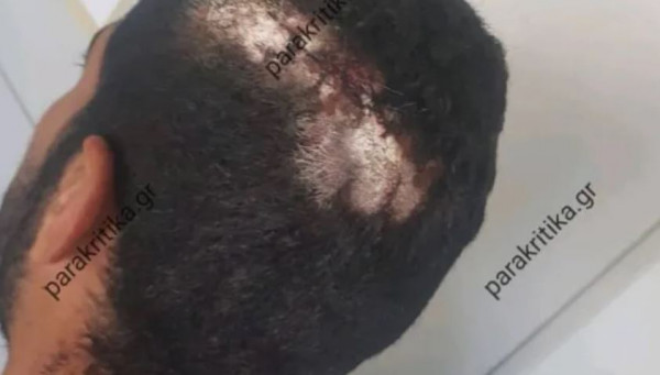 Χανιά: Τη Δευτέρα η δίκη του 47χρονου εργολάβου που κατηγορείται για ξυλοδαρμό 23χρονου εργάτη με αλυσίδα