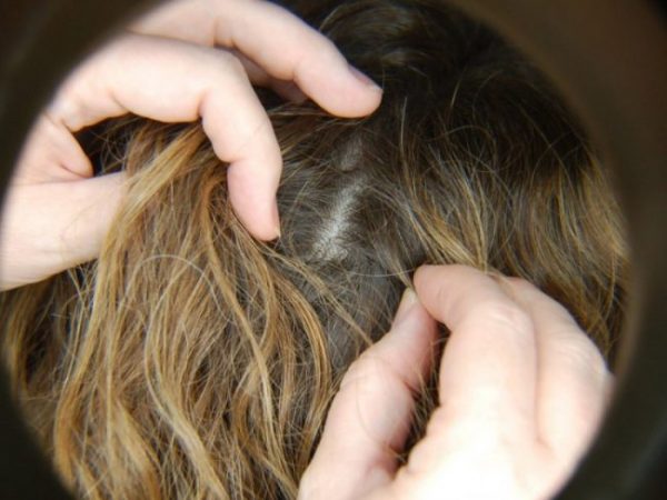 ΗΠΑ: Μαρτυρικός θάνατος για 9χρονη στην Αριζόνα – Την άφησαν να πεθάνει από ψείρες