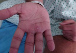 Ευλογιά των πιθήκων: Και δεύτερο θάνατο αναφέρει η Ισπανία – Δεκάδες στα νοσοκομεία