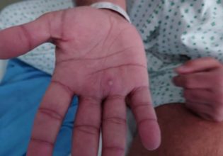 ΠΟΥ: Ανησυχία για την ευλογιά των πιθήκων – Πάνω από 14.000 κρούσματα