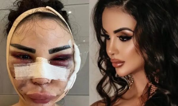 Ξόδεψε 600.000 δολάρια να μοιάζει με την Κιμ Καρντάσιαν και τώρα προσπαθεί να επανέλθει