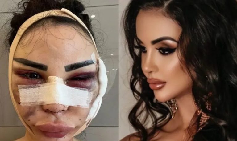 Ξόδεψε 600.000 δολάρια να μοιάζει με την Κιμ Καρντάσιαν και τώρα προσπαθεί να επανέλθει