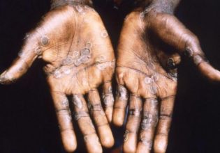 Ευλογιά των πιθήκων: Εφιάλτης για 26χρονο που κόλλησε – «Οι χειρότεροι πόνοι της ζωής μου»