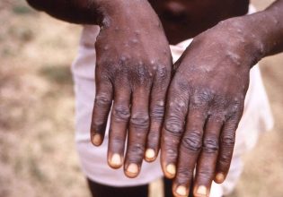 Φάουτσι για ευλογιά των πιθήκων: Υποεκτιμημένα τα κρούσματα – Πρέπει να τη λάβουμε σοβαρά υπ’όψιν