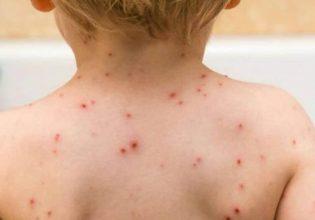 ΗΠΑ: Επιβεβαιώθηκε για πρώτη φορά ευλογιά των πιθήκων σε παιδιά – Νήπιο και βρέφος τα κρούσματα