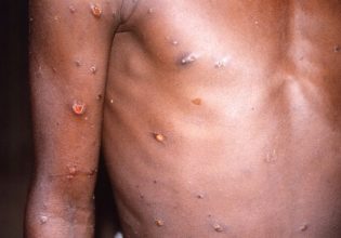 Ευλογιά των πιθήκων: Τι γνωρίζουμε έως σήμερα