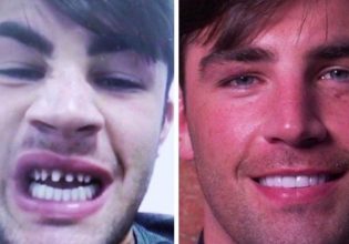 Βρετανία: Πάνε στην Τουρκία για να φτιάξουν φτηνά τα δόντια τους και επιστρέφουν φαφούτηδες