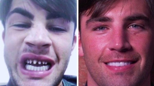 Βρετανία: Πάνε στην Τουρκία για να φτιάξουν φτηνά τα δόντια τους και επιστρέφουν φαφούτηδες