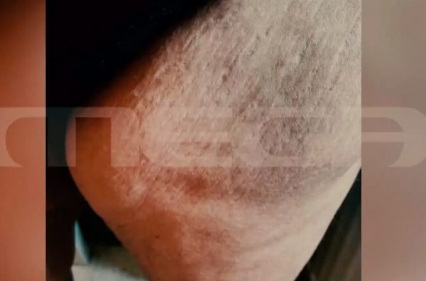 Θεσσαλονίκη: Συγκλονιστική μαρτυρία γυναίκας που παραμορφώθηκε σε κέντρο αισθητικής