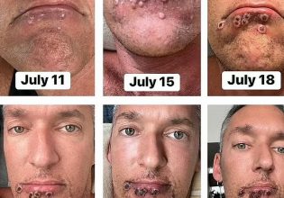 Κρούσμα της ευλογιάς των πιθήκων περιγράφει τον εφιάλτη που έζησε – Οι πόνοι και τα αηδιαστικά σπυράκια