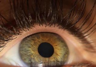 Καταρράκτης: Μια συχνή πάθηση των ματιών