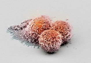 Καρκίνος της μήτρας: Νέο τεστ θα μπορούσε να μειώσει το χρόνο διάγνωσης