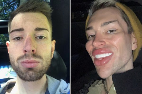 Έχει ξοδέψει 70.000 δολάρια σε πλαστικές για να μοιάζει στον… Κεν