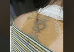 Αγνόησε τις οδηγίες για το νέο τατουάζ της, έκανε ηλιοθεραπεία και παραμορφώθηκε