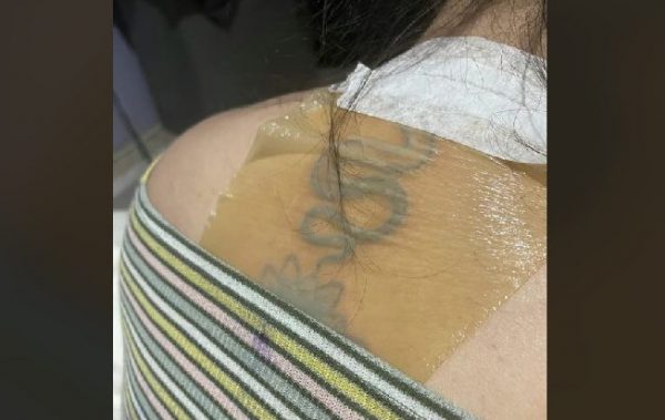 Αγνόησε τις οδηγίες για το νέο τατουάζ της, έκανε ηλιοθεραπεία και παραμορφώθηκε