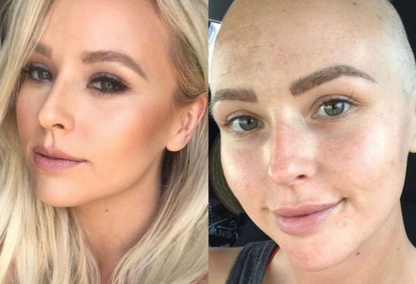 Της αρνήθηκαν μαστογραφία γιατί ήταν πολύ νέα – 8 μήνες αργότερα διαγνώστηκε με καρκίνο του μαστού 4ου σταδίου