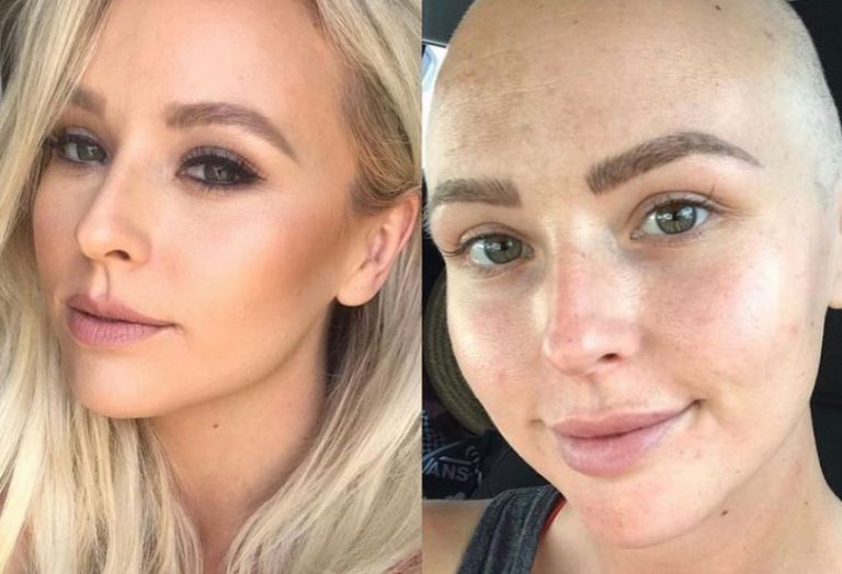 Της αρνήθηκαν μαστογραφία γιατί ήταν πολύ νέα – 8 μήνες αργότερα διαγνώστηκε με καρκίνο του μαστού 4ου σταδίου