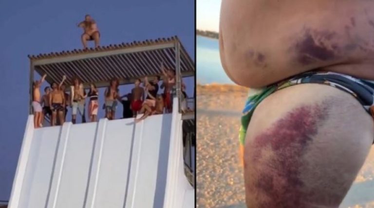 Κι όμως πλήρωσε το άλμα «θανάτου» από τη νεροτσουλήθρα – Το κορμί του έγινε μωβ από τις μελανιές