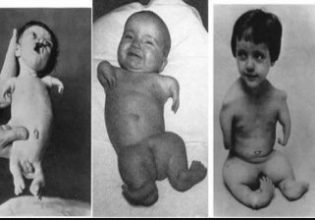 Θαλιδομίδη: Τα παραμορφωμένα παιδιά ενός «αθώου» χαπιού