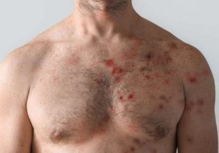 Βέλγιο: Πρώτος θάνατος εξαιτίας της ευλογιάς των πιθήκων