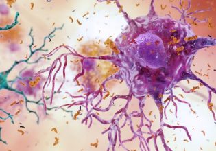 Νέες δομές περίθαλψης για ασθενείς με Αλτζχάιμερ