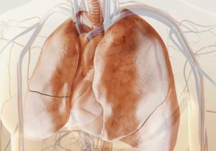 Στον πνευμονολόγο για έγκαιρη διάγνωση της πνευμονικής ίνωσης
