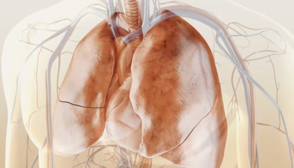 Στον πνευμονολόγο για έγκαιρη διάγνωση της πνευμονικής ίνωσης