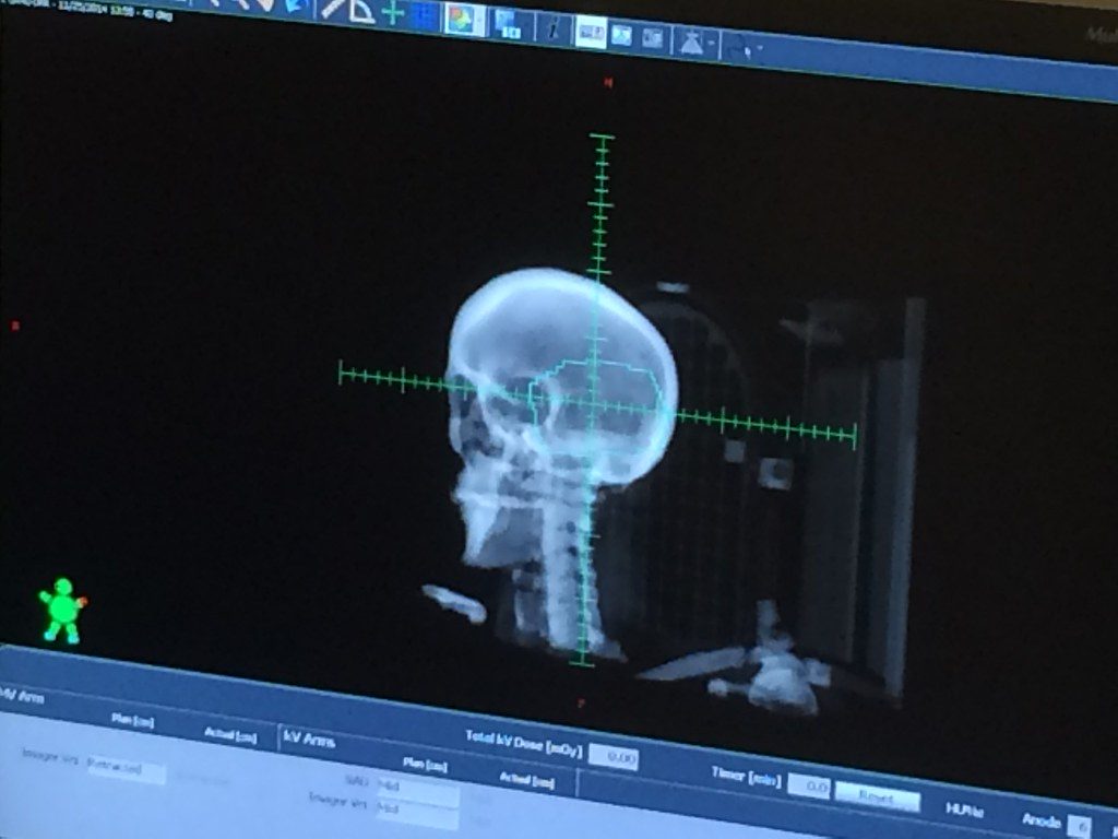 Εξάλειψαν το γλοιοβλάστωμα όταν του «έκοψαν» την τροφή