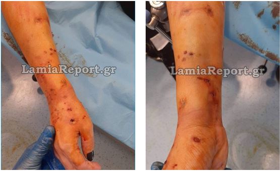 Λαμία: Άγρια επίθεση σκύλου σε 35χρονη - Υπέστη κάταγμα το δεξί χέρι της