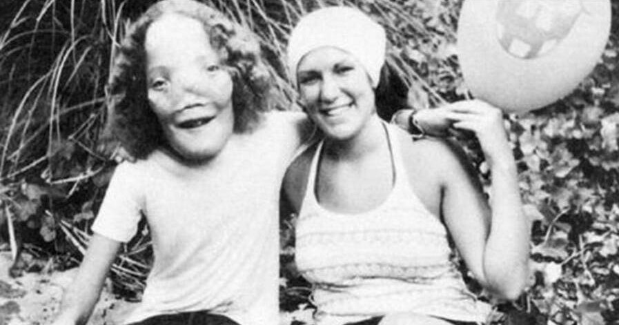 Ρόι Ντένις: Η σπάνια ασθένεια του «παιδιού με τη μάσκα» που αντιμετωπιζόταν ως «τέρας»