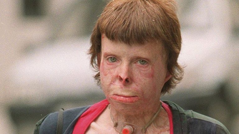 Την έλουσε με βενζίνη και της έβαλε φωτιά – Πέθανε 21 χρόνια μετά και τώρα δικάζεται για τον φόνο της