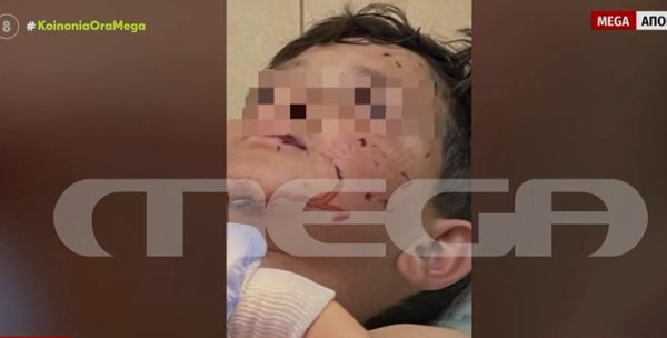 Λαγονήσι: Τι λέει η μητέρα του 14χρονου που δέχθηκε επίθεση από σκύλο